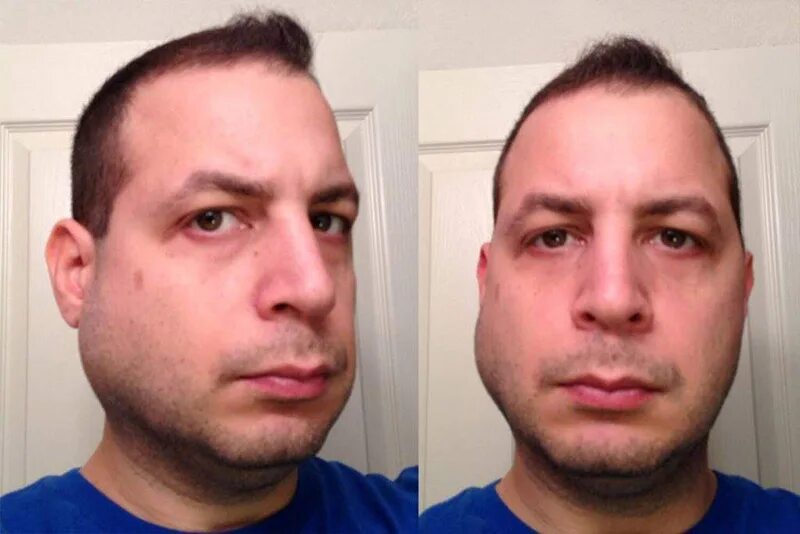 Перелом носа фото до и после.