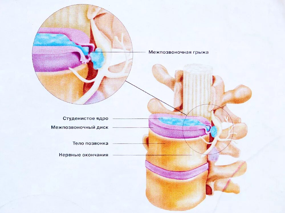 Содержимое межпозвоночного диска. Анатомия межпозвонкового диска. Пульпозное ядро межпозвоночного диска. Фиброзное кольцо и студенистое ядро. Студенистое ядро позвоночника.