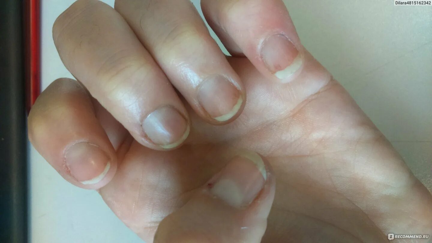 Аллергия на гель лак для ногтей. Травматичный онихолизис. Аллергия на гель лак для ногтей. Аллергическая реакция на гель лак. Аллергия на ультрафиолетовую лампу для сушки ногтей.