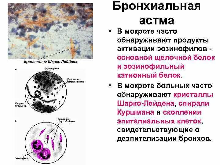 Анализ мокроты при астме. Спирали Куршмана, Кристаллы Шарко-Лейдена, эозинофилы. Спирали Куршмана и Кристаллы Шарко-Лейдена. Микроскопия мокроты спирали Куршмана. Спирали Куршмана Кристаллы Шарко- Лейдена при бронхиальной астме.