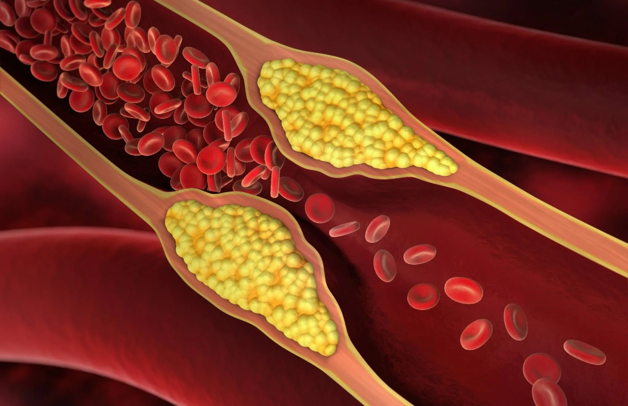 Жировые бляшки в сосудах. Холестериновые бляшки на теле. Кровяные бляшки в сосудах.