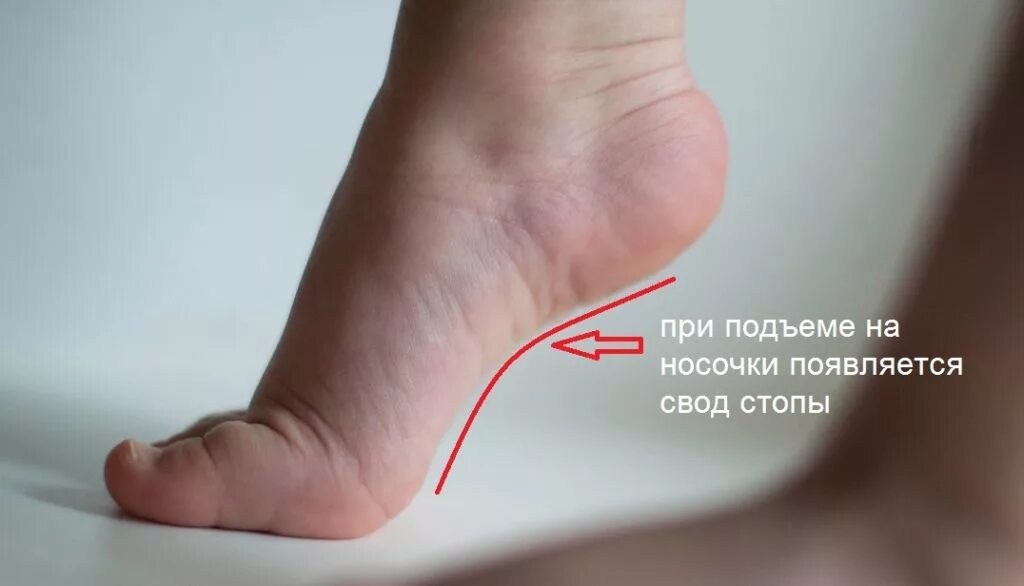 подъем стопы у ребенка. высокий подъем стопы у ребенка. подъем стопы у ребенка. высокий и низкий взъем ноги. врожденное плоскостопие.