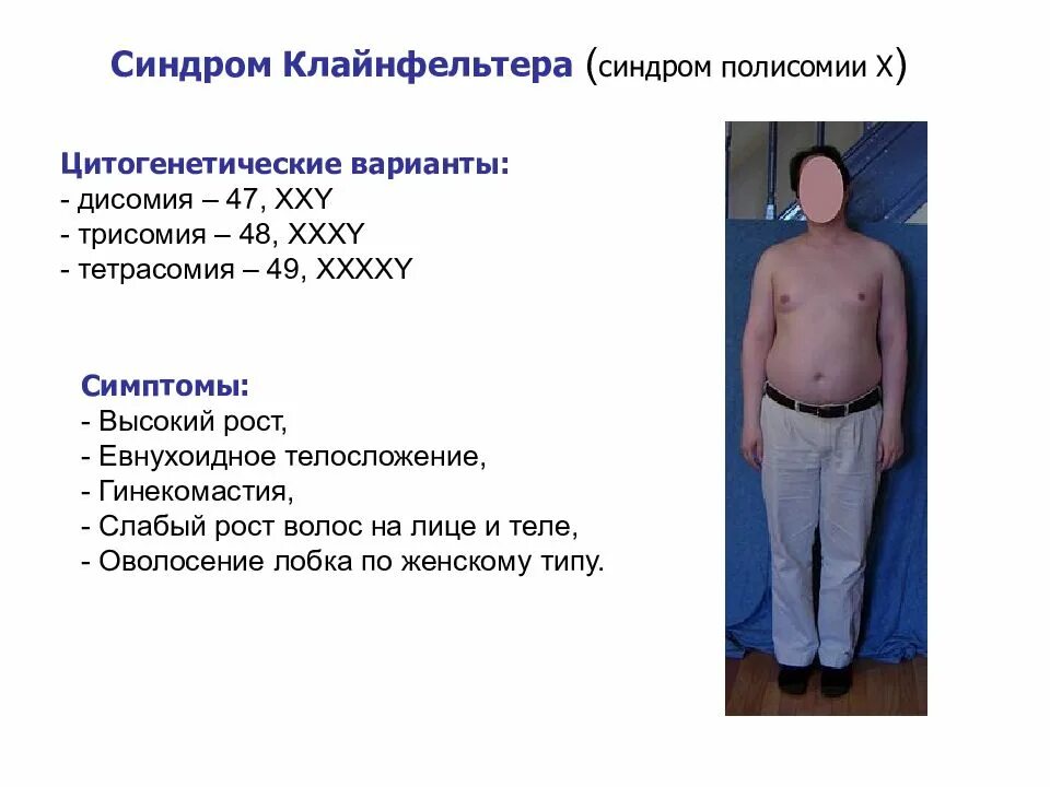 Клайнфельтера ожирение. Евнухоидные пропорции тела. Евнуховидный тип телосложения. Лишняя хромосома синдром клайнфельтера. Евнухоидное телосложение.