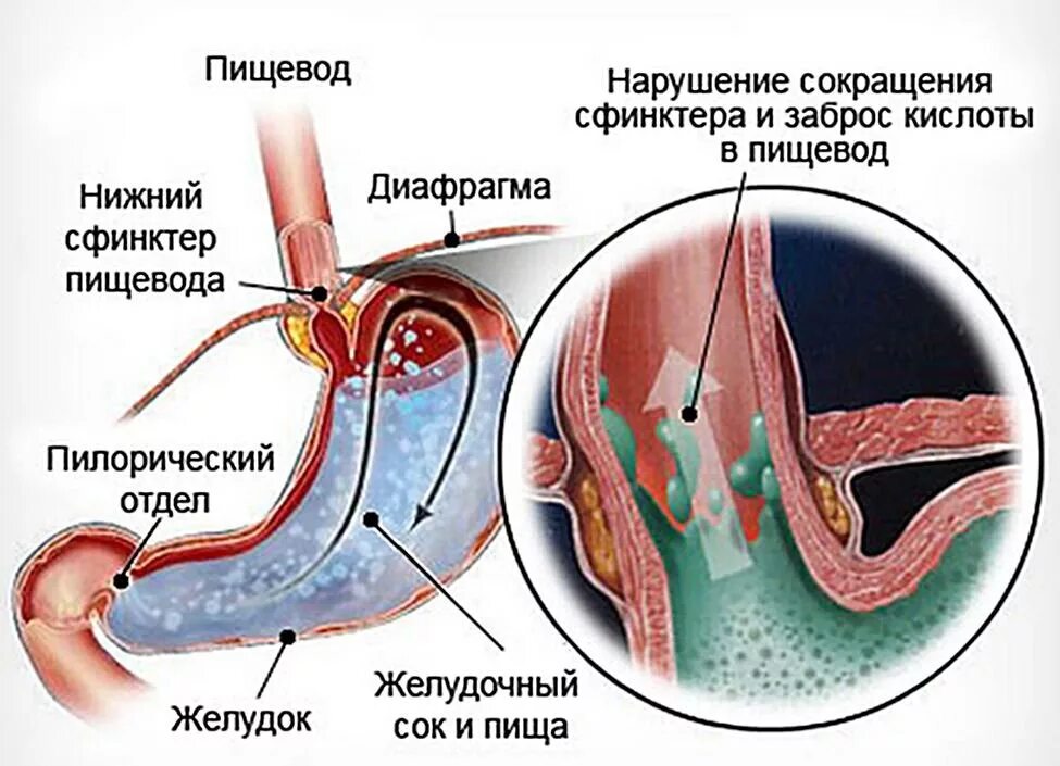 Нижний рефлюкс