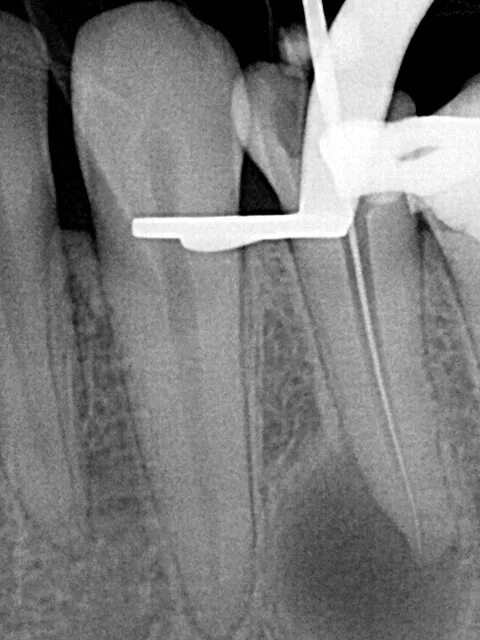 плохо проходимых каналов. отлом эндодонтического инструмента в канале корня. резорцин формалиновый зуб. прохождение корневого канала. методы лечения труднопроходимых корневых каналов.