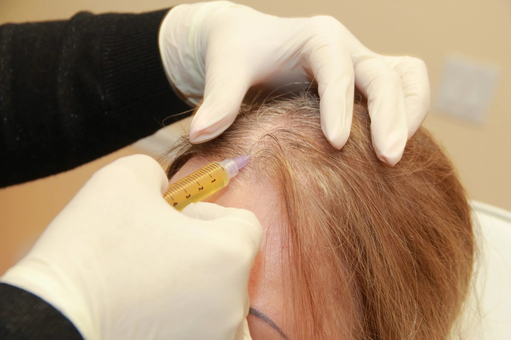 Плазмотерапия для волос. PRP плазмолифтинг для волос. Плазмотерапия волосистой части головы. PRP-терапия (плазмотерапия) для волос.