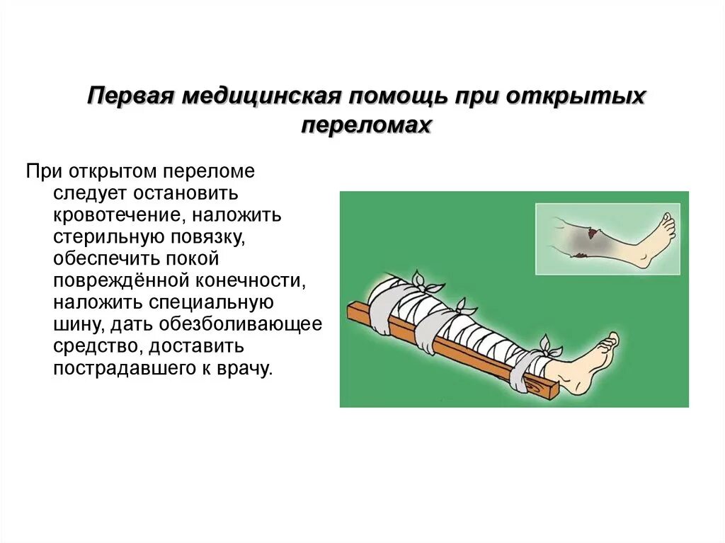 При открытом переломе ответ на тест. ПМП при открытом переломе. Последовательность оказания ПМП при открытом переломе:. Оказания первой медицинской помощи при открытых переломах костей. Как оказать первую медицинскую помощь при открытых переломах?.