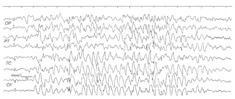Ээг рязань. ЭЭГ при болезни Паркинсона. ЭЭГ при фенилкетонурии. ЭЭГ 50 МКВ. Спайк волна на ЭЭГ.