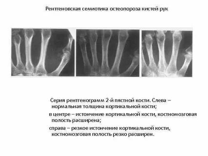 Остеопороз кистей