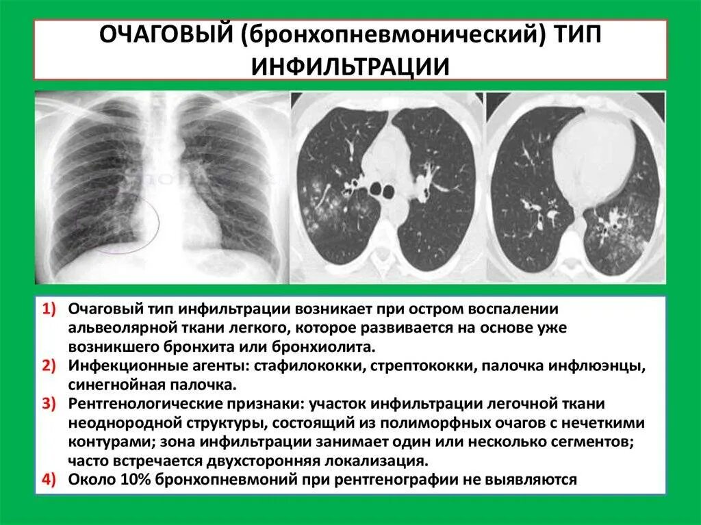 Типы инфильтрации при пневмонии. Инфильтрация легочной ткани на кт. Альвеолярный Тип инфильтрации при пневмонии рентген. Очаговый бронхопневмонический Тип инфильтрации. Диагноз с 2 легкого