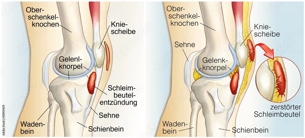 Tut weh. Knie. Schienbein. Кайзер auf die Knie.