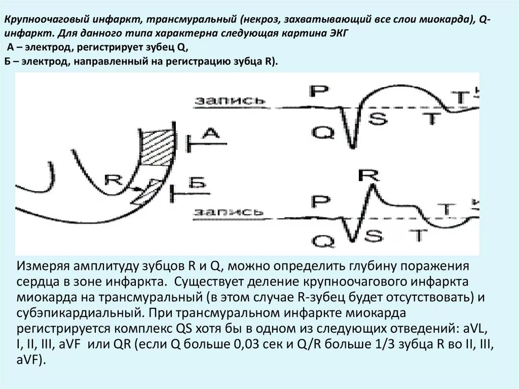 Изменение зубца q. Признак острого крупноочагового инфаркта миокарда. ЭКГ не трансмуральный q инфаркт миокарда. Крупноочаговый и мелкоочаговый инфаркт миокарда отличия. ЭКГ при крупноочаговом инфаркте миокарда.