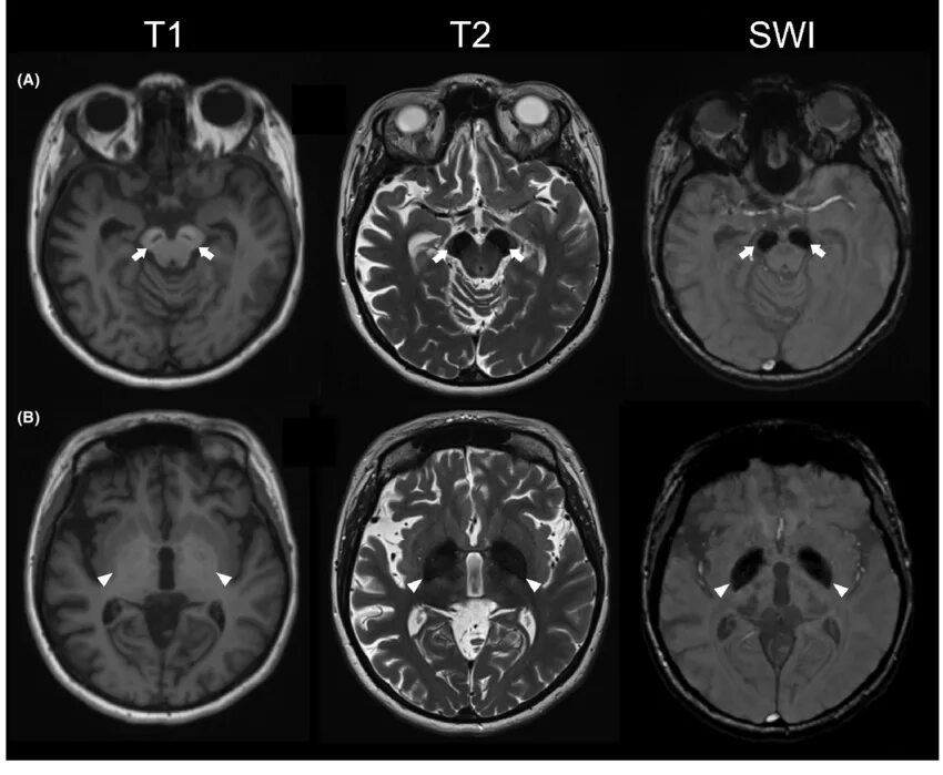 1 brain for 2. MRI Brain t1. T1 + GD MRI. Brain tumors мрт. Аксиал в мрт головы.
