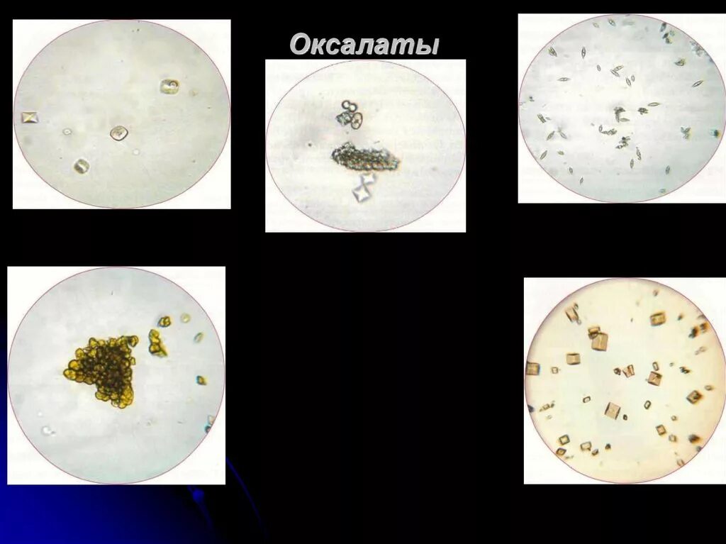Кристаллы оксалата в моче у мужчин. Соли щавелевой кислоты оксалаты. Оксалаты микроскопия мочи. Осадок мочи оксалаты. Оксалаты в моче под микроскопом.