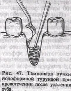 Удаление зуба тампон