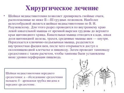 Хирургическое лечение медиастинитов