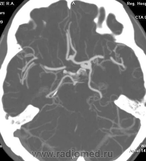 Виллизиев круг вариант развития на мрт. Виллизиев круг мрт. Кт анатомия Виллизиева круга. Виллизиев круг на кт. Сосуды виллизиевого круга мрт.