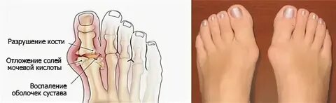 Почему растут косточки на пальцах