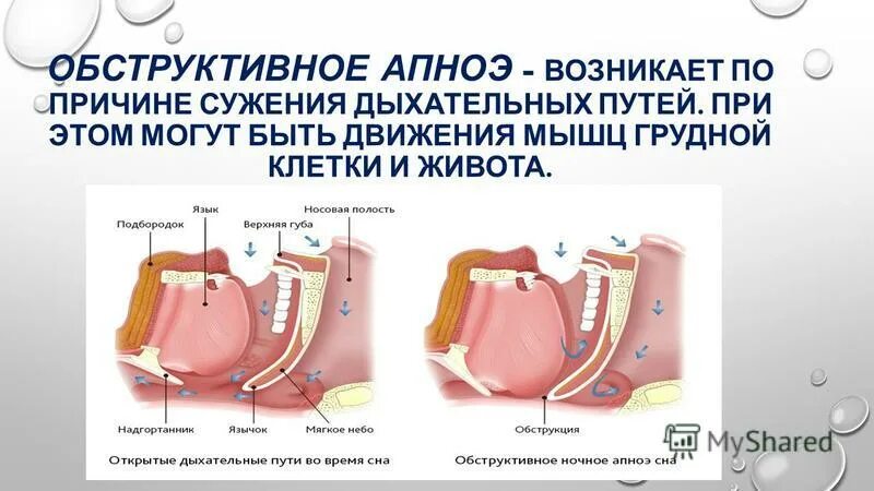 Апноэ что это такое у взрослых. Обструктивное апноэ сна. синдром обструктивного апноэ сна. апноэ во сне причины. сужение дыхательных путей причины.