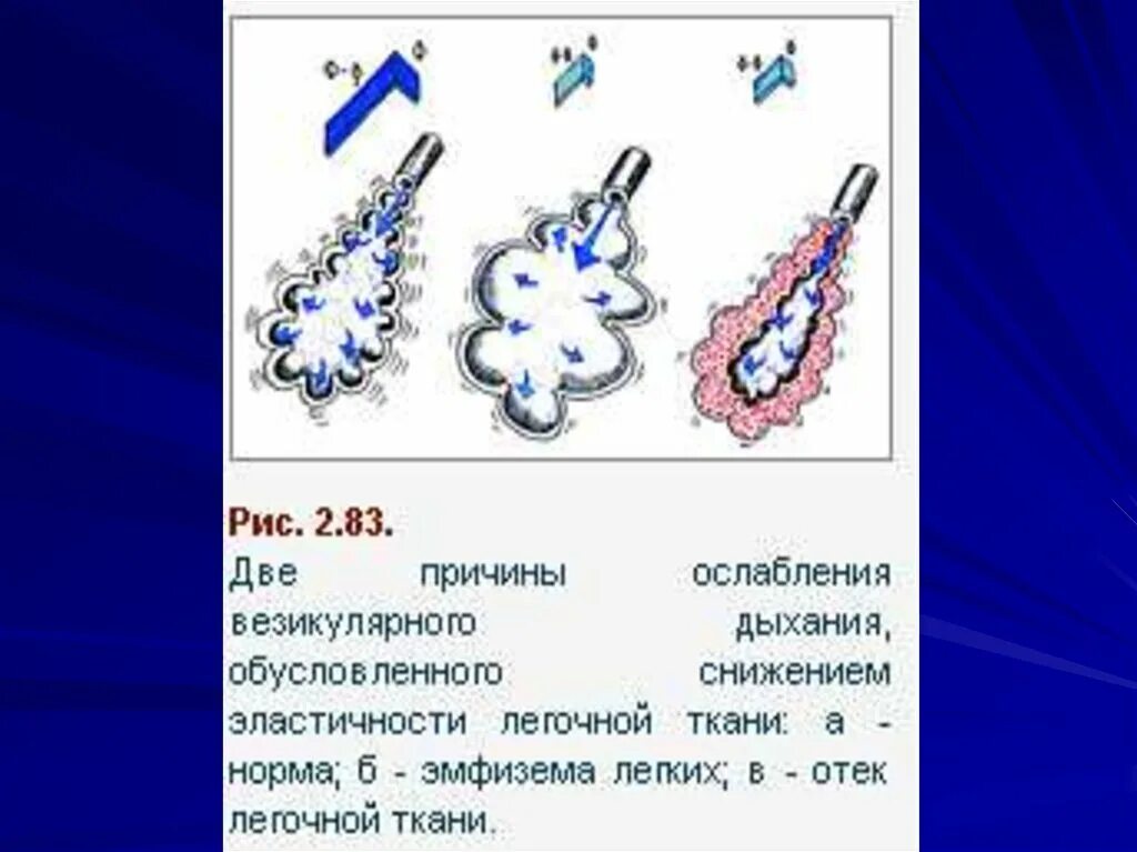 Ослабленное везикулярное дыхание при эмфиземе. Ослабление везикулярного дыхания. Причины ослабления везикулярного дыхания. Везикулярное дыхание в норме и патологии. Дыхание ясное везикулярное