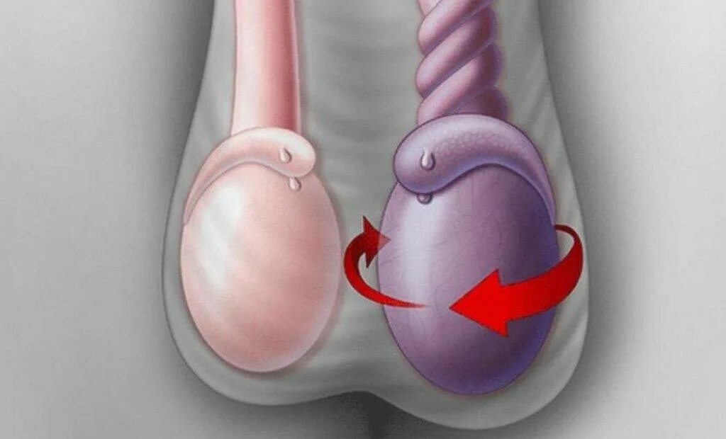 Перекрут семенного канатика. Перекрут гидатиды яичка. Гидроцеле операция Винкельмана. Ниже яиц у мужчин
