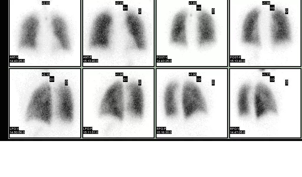 Сканирование легких. Ventilation/perfusion scan. сканирование легких вентиляция перфузия. легкие на сканере. v/q сканирование.