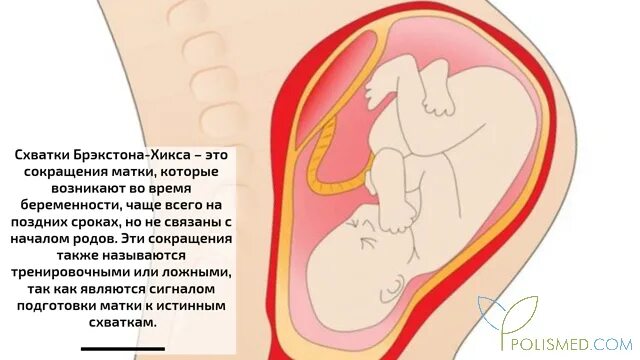 Схватки хиггса. Схватки. Схватки по Брэкстону. Схватки по Брэкстону Хиксу. Сокращения Брэкстона Хикса.