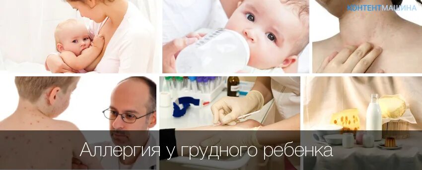 Аллергия на коровье молоко симптомы. Симптомы непереносимости белка у грудничка. Симптомы непереносимости белка у грудничка. Стмоомы непернасимости лактоз ы. Аллергия на коровье молоко у ребенка.