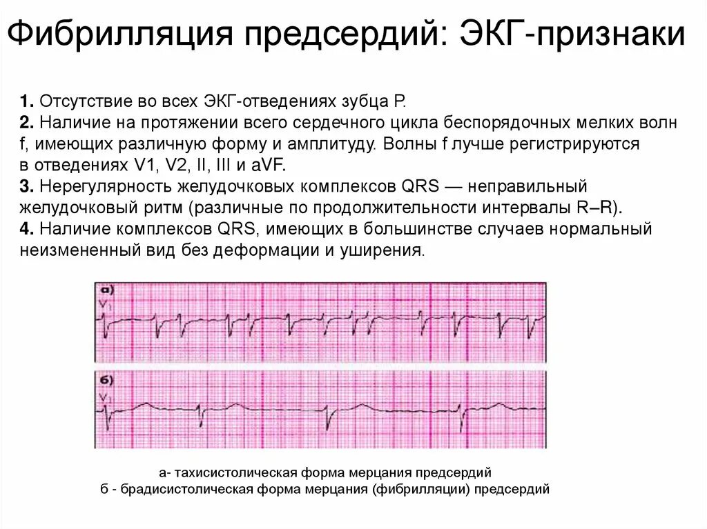 Фибрилляция предсердий причины и симптомы