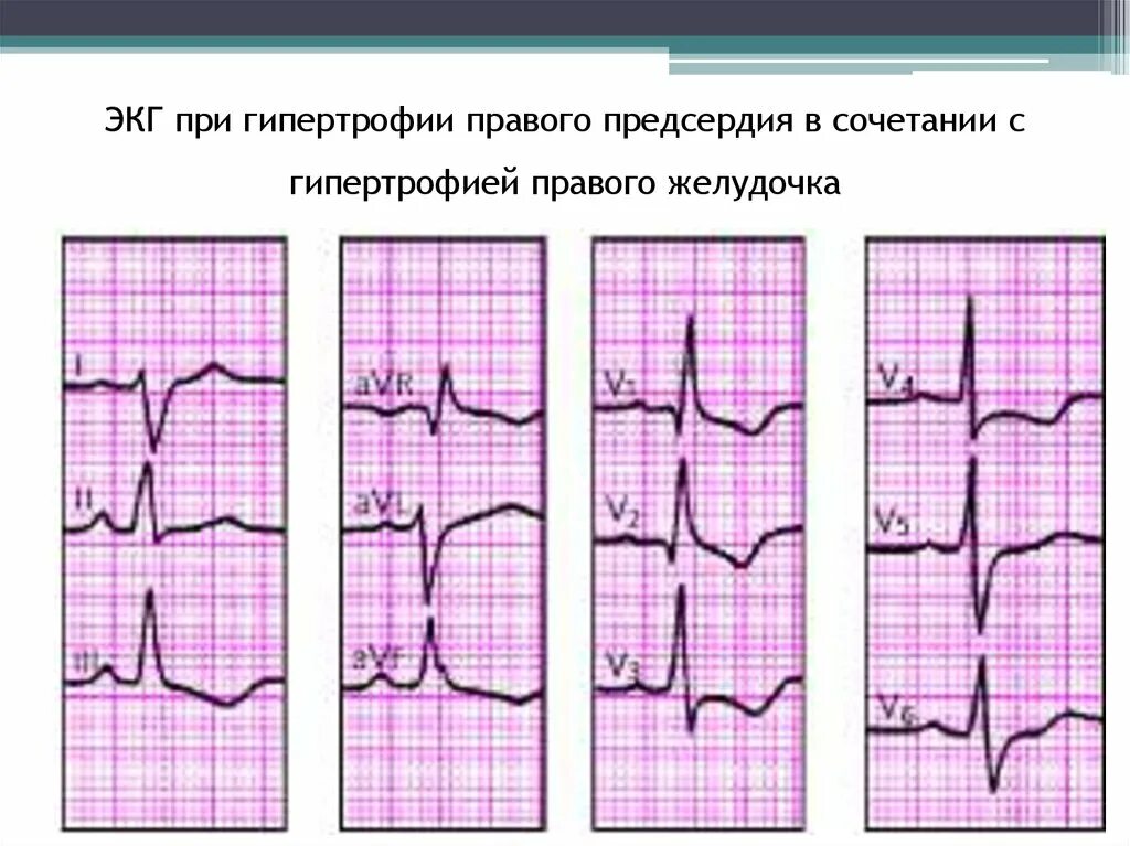 Гипертрофия предсердий на ЭКГ. Гипертрофия левого предсердия на ЭКГ. Гипертрофия правого предсердия на ЭКГ. ЭКГ при гипертрофии предсердий и желудочков. Гипертрофия левого предсердия левого желудочка