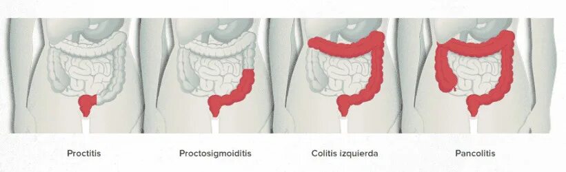Осложнения травм прямой кишки. Как помочь прямой кишки. Хирургические заболевания прямой кишки. Как помочь прямой кишки. Воспаление прямой кишки.