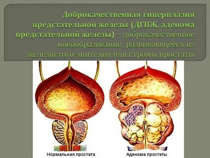 Дгпж это в урологии