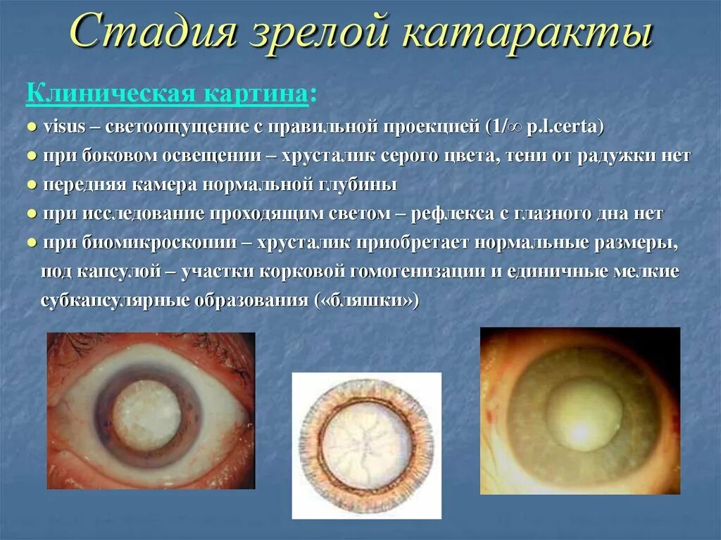 Начальная старческая катаракта. Возрастная катаракта незрелая стадия. Начальная фаза развития катаракты. Переднекапсулярная катаракта. Незрелая возрастная катаракта осложнения.