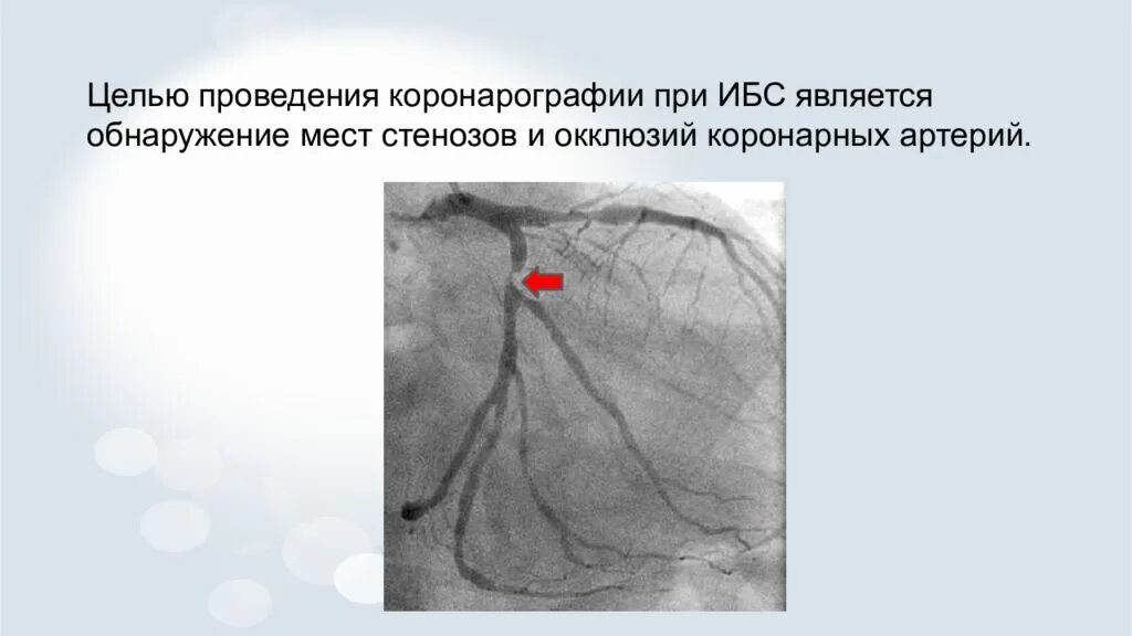 Коронарография сосудов. Коронарография картинки. Коронарография заключение. Коронарография окклюзия.