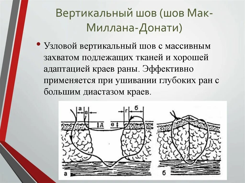 Вертикальный матрацный шов донати. Вертикальный матрацный шов донати. Вертикальный матрацный шов по донати. Шов по донати техника. Шов мак-миллана –донати.
