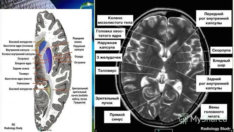 кт головного мозга с метионином