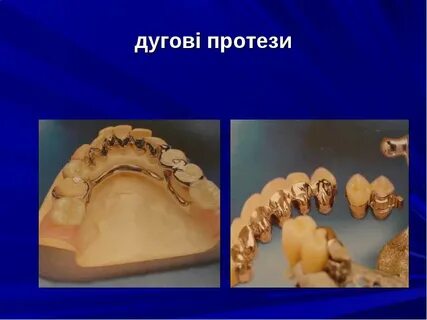Дуговой протез