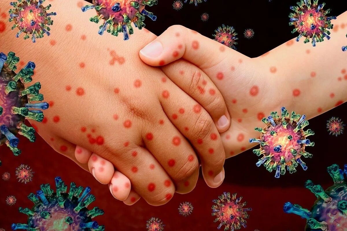 Вирусные заболевания людей доклад корь. Вирус кори человека. Вирус кори человека. Корь характеристика возбудителя. Возбудитель кори микробиология.