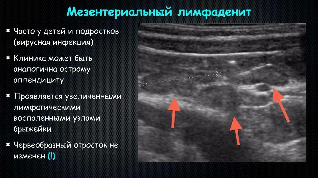 Увеличение лимфоузлов селезенки. Мезентериальные лимфатические узлы УЗИ. Лимфаденит УЗИ лимфоузлов. Брыжеечные лимфатические узлы на УЗИ. Признаки лимфаденопатии на УЗИ.