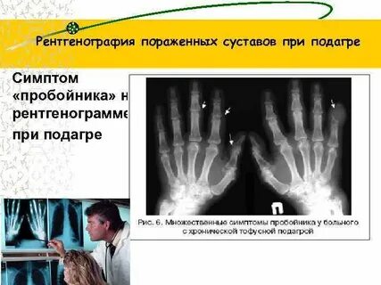 Рентгенологические признаки подагры