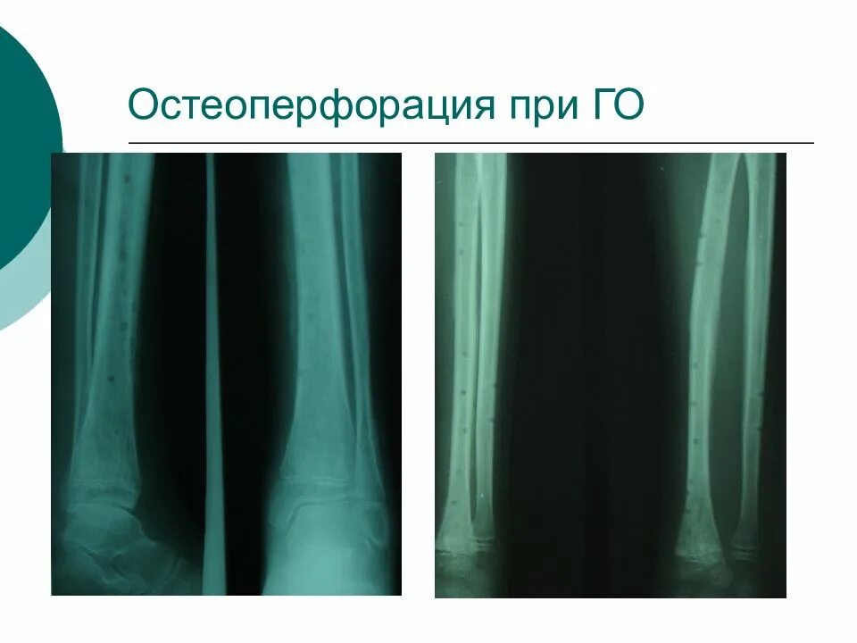 Декомпрессионная остеоперфорация. Остеотонометрия. Техника раннего воспоминания по адлеру. Антибактериальная терапия остеомиелита. Ранние воспоминания.