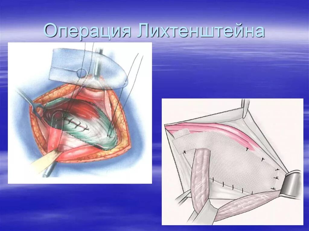 Лихтенштейн операция паховая