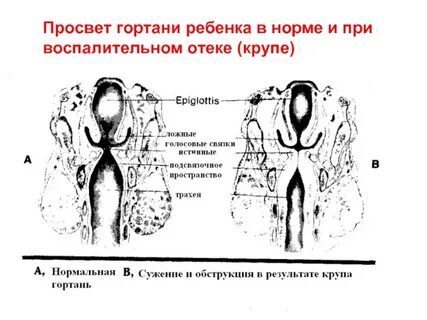 Развитие гортани