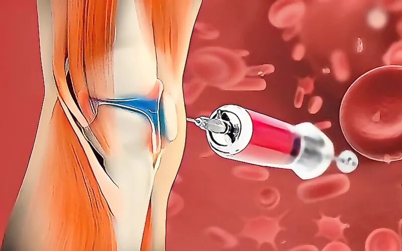 PRP терапия Platelet Rich Plasma. PRP терапия плечевого сустава. Плазмолифтинг PRP терапия коленного сустава. Плазмотерапия суставов (PRP-терапия, плазмолифтинг).