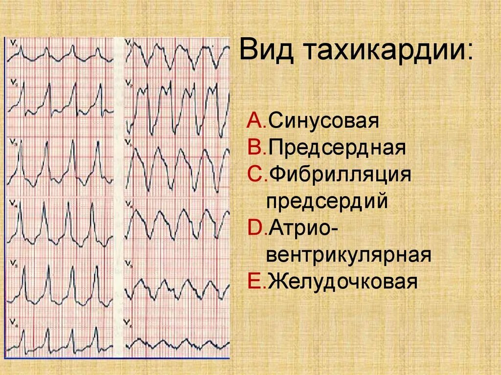 Тахикардия. Виды тахикардии. Симптомы при тахикардии. Синусовая тахикардия виды. Тахикардия осложнения