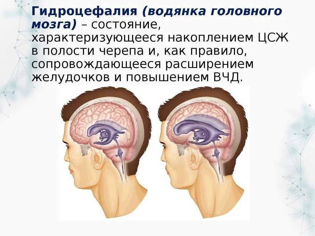Причины гидроцефалии мозга. Гидроцефалия водянка головного мозга. Мультилокулярная гидроцефалия. Гидроцефалия головного мозга у ребенка. Гидроцефалия головного мозга у взрослого.