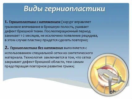 Герниопластика это
