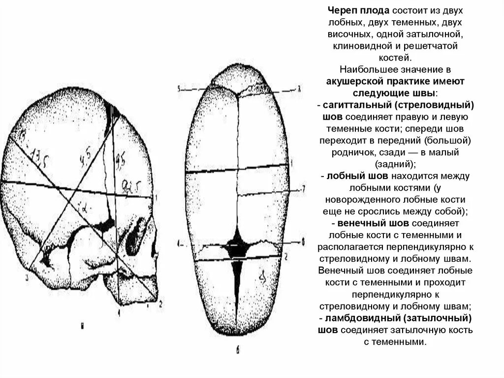 Швы черепа плода. Теменные кости плода. Лобный шов в правом косом размере.