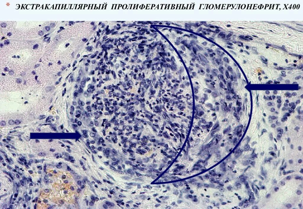 Интракапиллярный гломерулонефрит. Быстропрогрессирующий гломерулонефрит патанатомия. экстракапиллярный гломерулонефрит микропрепарат. экстракапиллярный гломерулонефрит патанатомия. интракапиллярный гломерулонефрит микропрепарат.