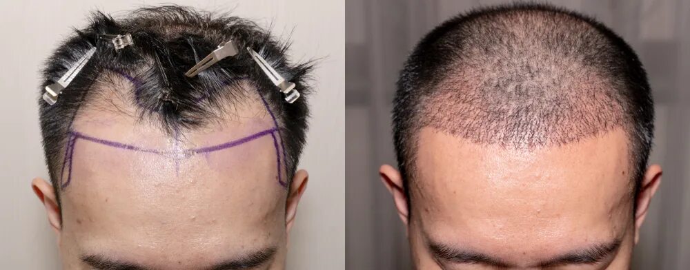 Пересадка волос донорская зона. Голова после пересадки волос. Шрамы после пересадке волос. Трансплантация волос с затылка.